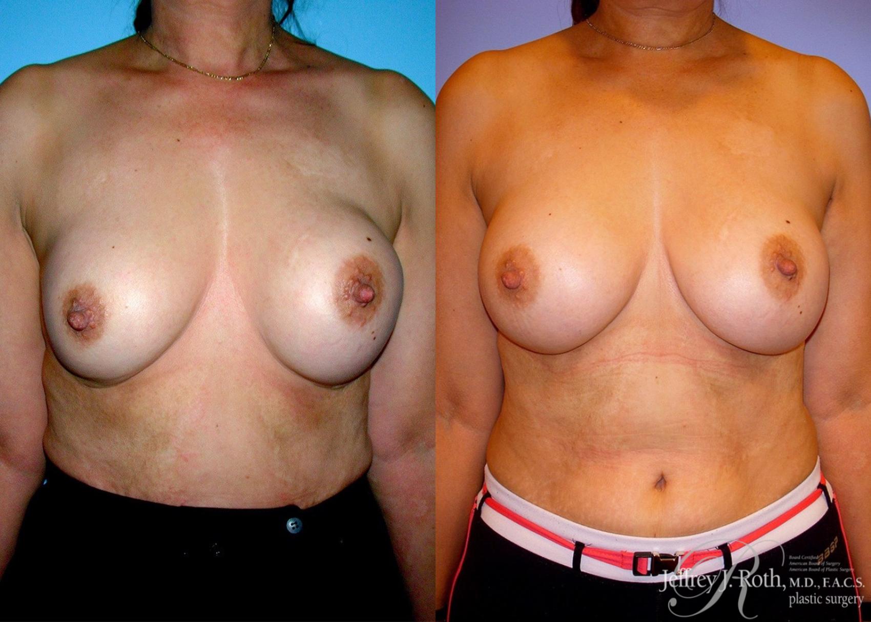 Before & After Breast Augmentation Revision Case 103 View #1 View in Las Vegas, NV