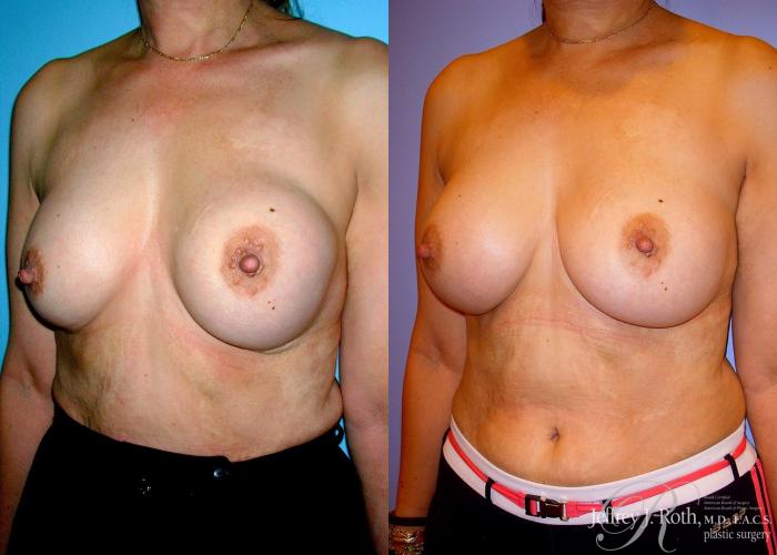 Before & After Breast Augmentation Revision Case 103 View #2 View in Las Vegas, NV