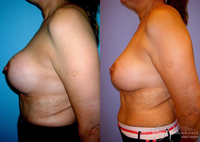 Before & After Breast Augmentation Revision Case 103 View #3 View in Las Vegas, NV