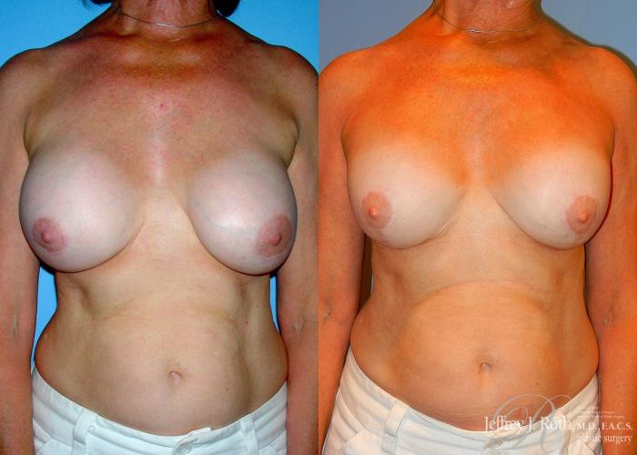Before & After Breast Augmentation Revision Case 104 View #1 View in Las Vegas, NV