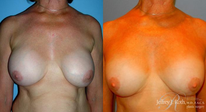 Before & After Breast Augmentation Revision Case 104 View #2 View in Las Vegas and Henderson, NV