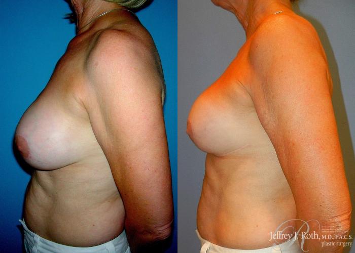 Before & After Breast Augmentation Revision Case 104 View #3 View in Las Vegas and Henderson, NV