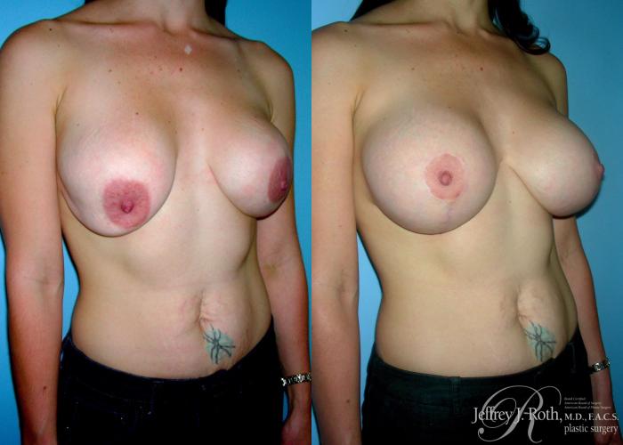Before & After Breast Augmentation Revision Case 105 View #2 View in Las Vegas, NV