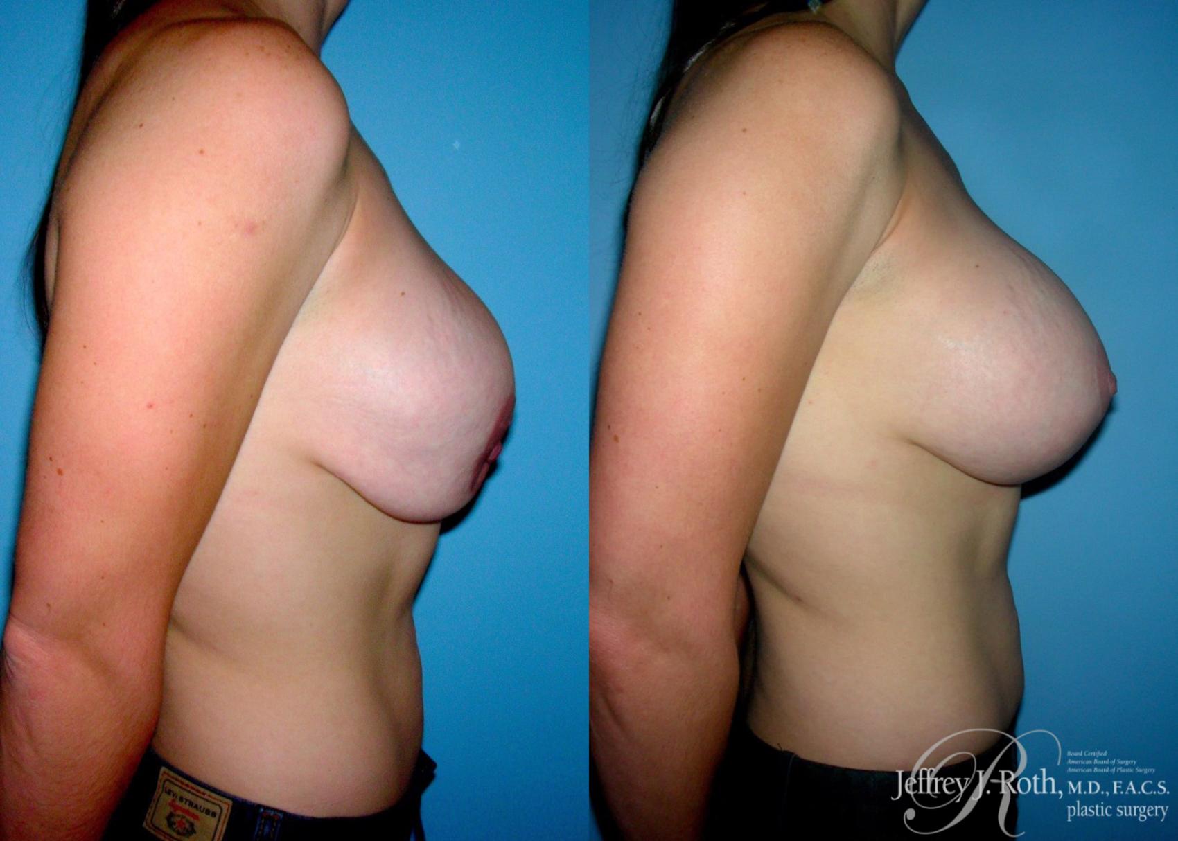 Before & After Breast Augmentation Revision Case 105 View #3 View in Las Vegas and Henderson, NV