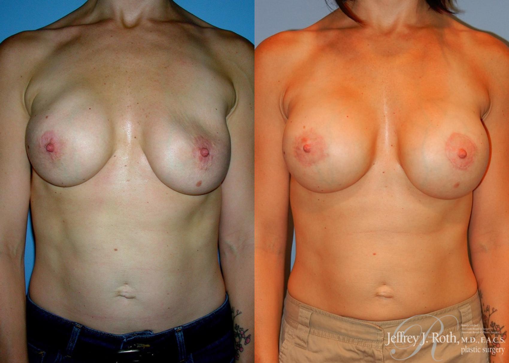 Before & After Breast Augmentation Revision Case 106 View #1 View in Las Vegas, NV