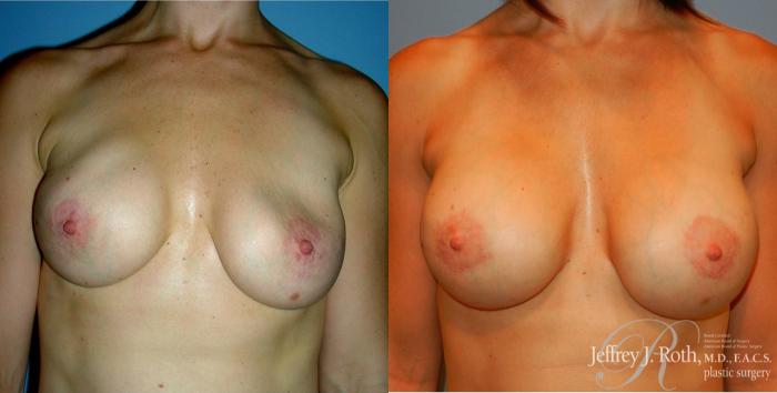Before & After Breast Augmentation Revision Case 106 View #2 View in Las Vegas, NV