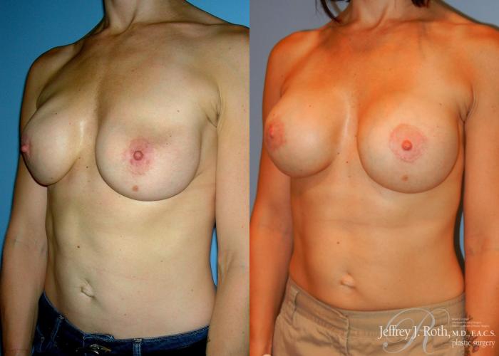 Before & After Breast Augmentation Revision Case 106 View #3 View in Las Vegas, NV