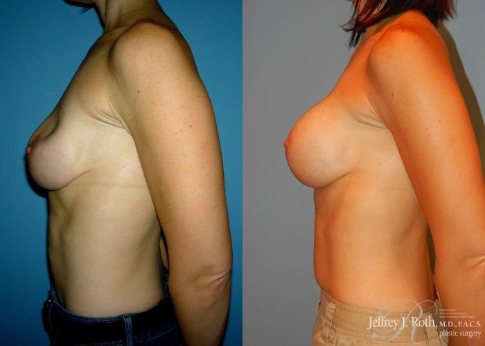 Before & After Breast Augmentation Revision Case 106 View #4 View in Las Vegas, NV