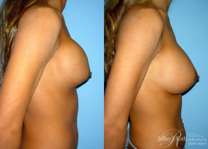 Before & After Breast Augmentation Revision Case 107 View #3 View in Las Vegas and Henderson, NV