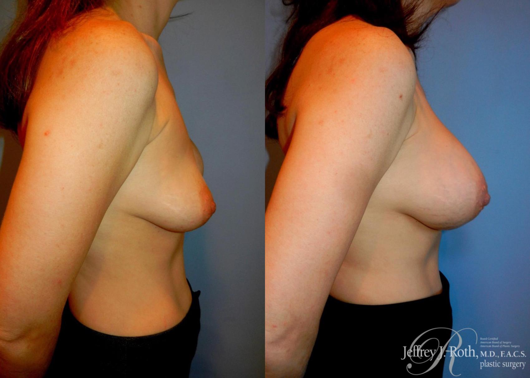 Before & After Breast Augmentation Revision Case 108 View #3 View in Las Vegas, NV