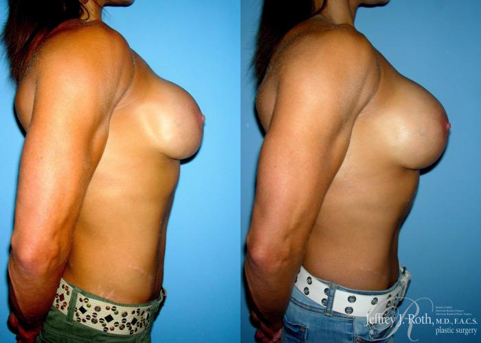 Before & After Breast Augmentation Revision Case 109 View #3 View in Las Vegas, NV
