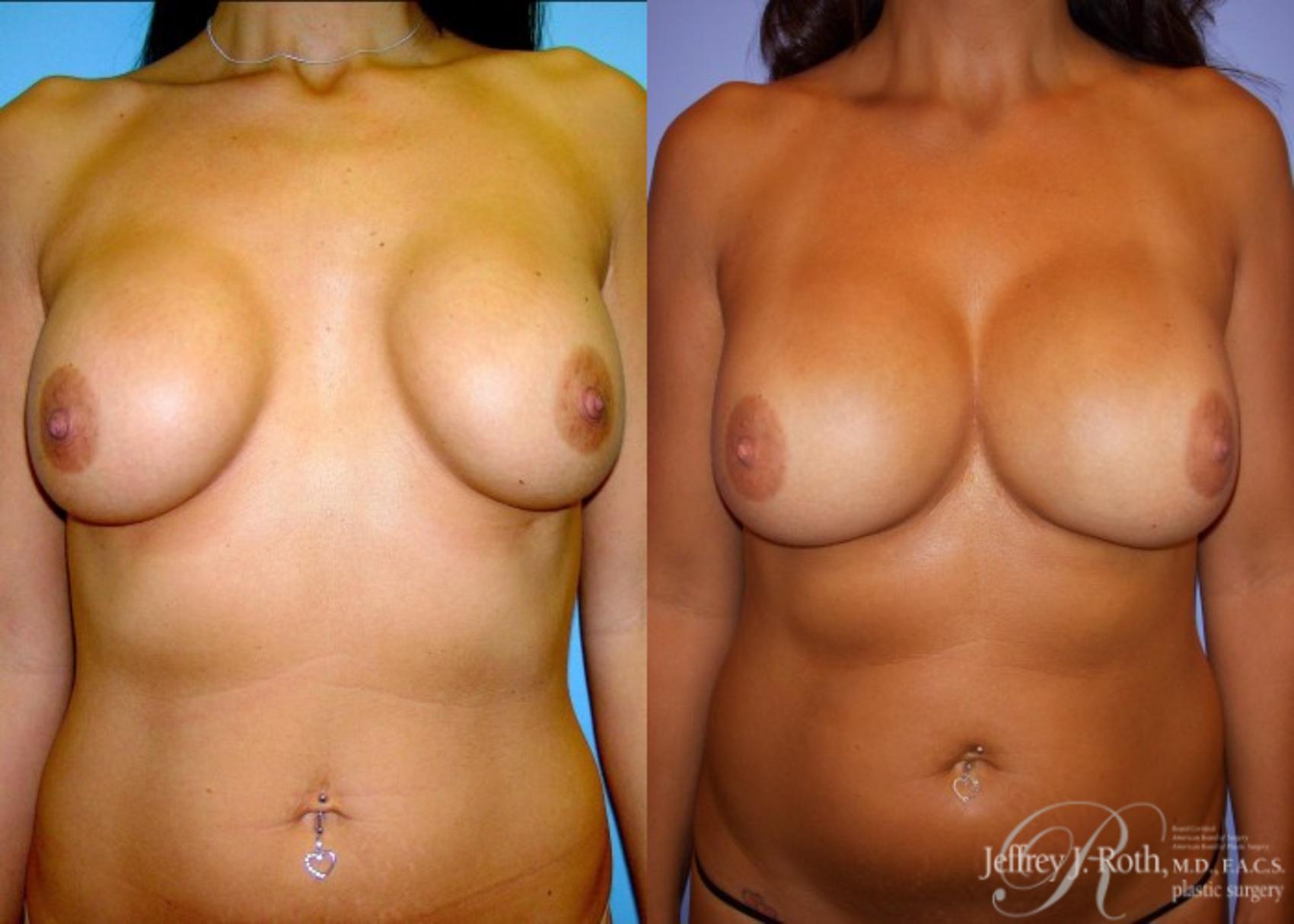 Before & After Breast Augmentation Revision Case 110 View #1 View in Las Vegas and Henderson, NV