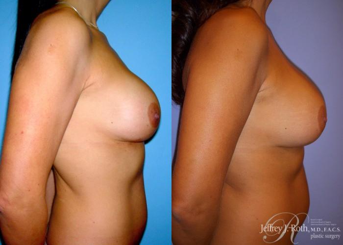 Before & After Breast Augmentation Revision Case 110 View #3 View in Las Vegas, NV