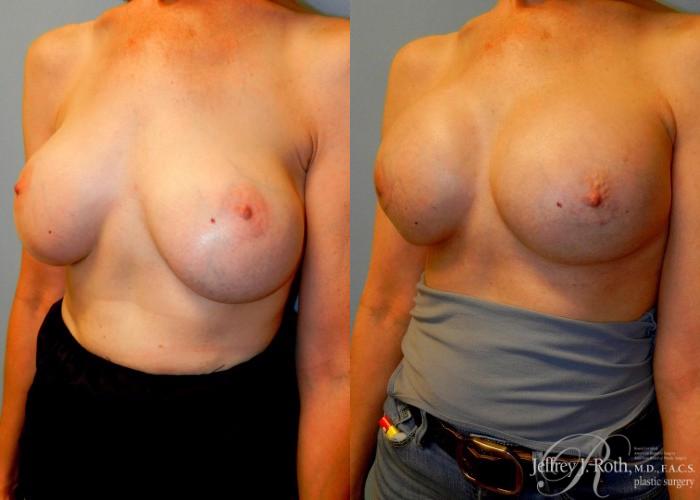 Before & After Breast Augmentation Revision Case 111 View #2 View in Las Vegas and Henderson, NV