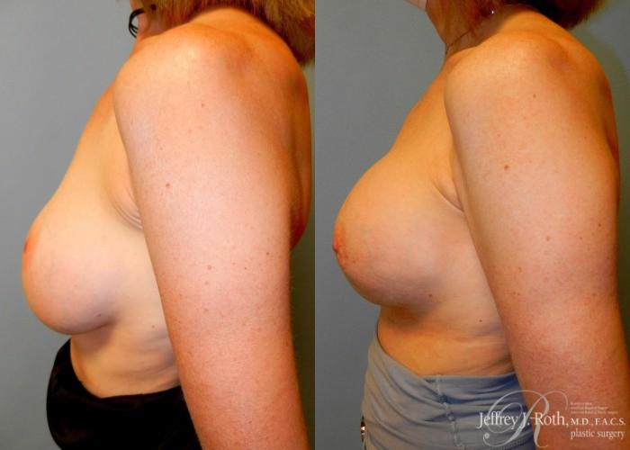 Before & After Breast Augmentation Revision Case 111 View #3 View in Las Vegas, NV