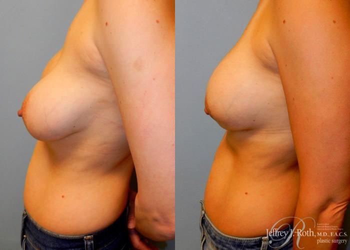 Before & After Breast Augmentation Revision Case 112 View #3 View in Las Vegas and Henderson, NV
