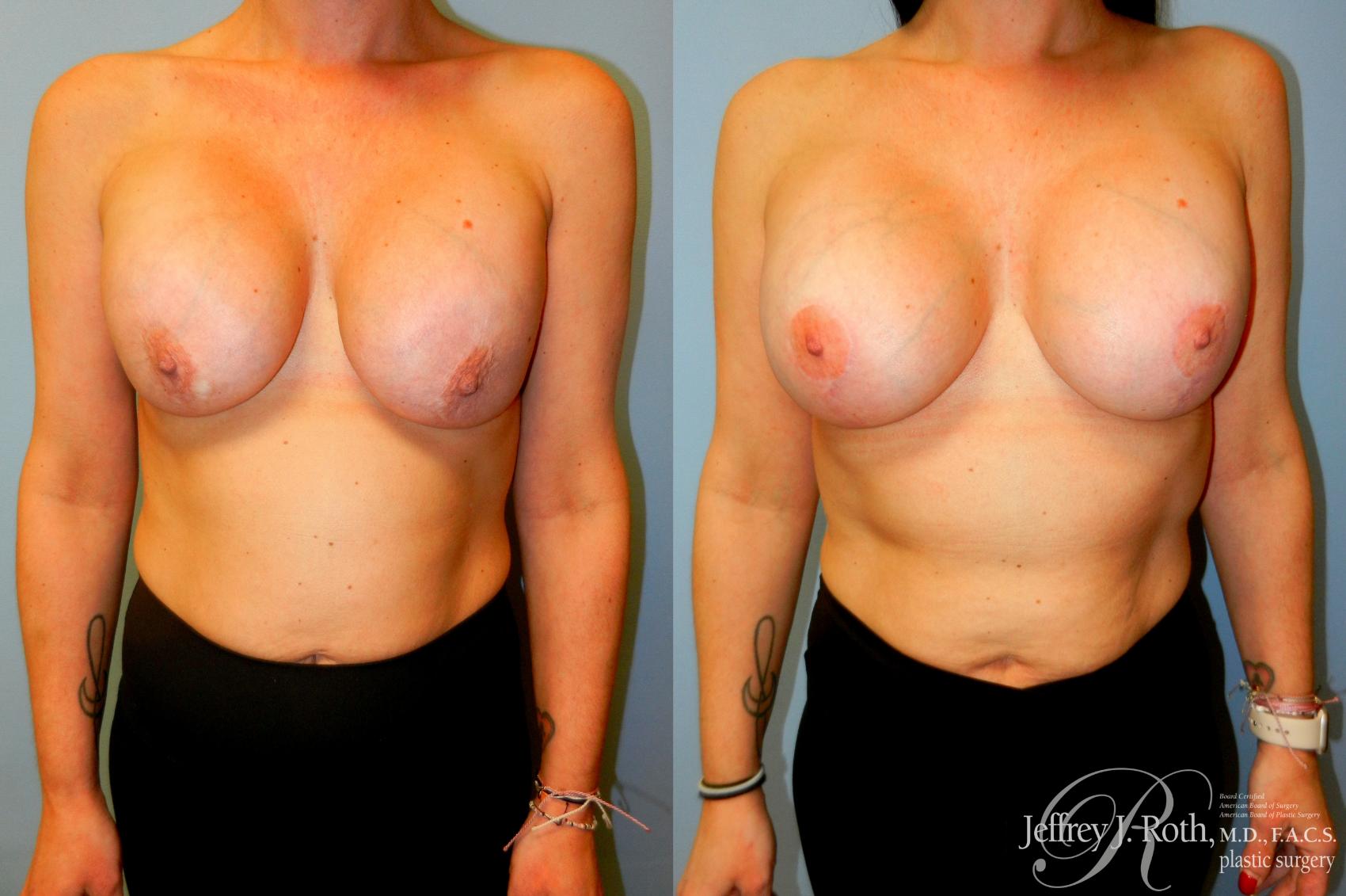 Before & After Breast Augmentation Revision Case 251 Front View in Las Vegas and Henderson, NV