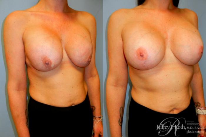 Before & After Breast Augmentation Revision Case 251 Right Oblique View in Las Vegas and Henderson, NV