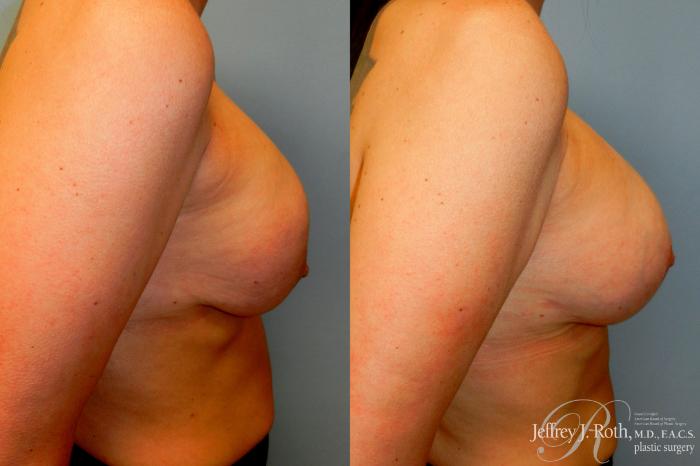 Before & After Breast Augmentation Revision Case 251 Right Side View in Las Vegas and Henderson, NV
