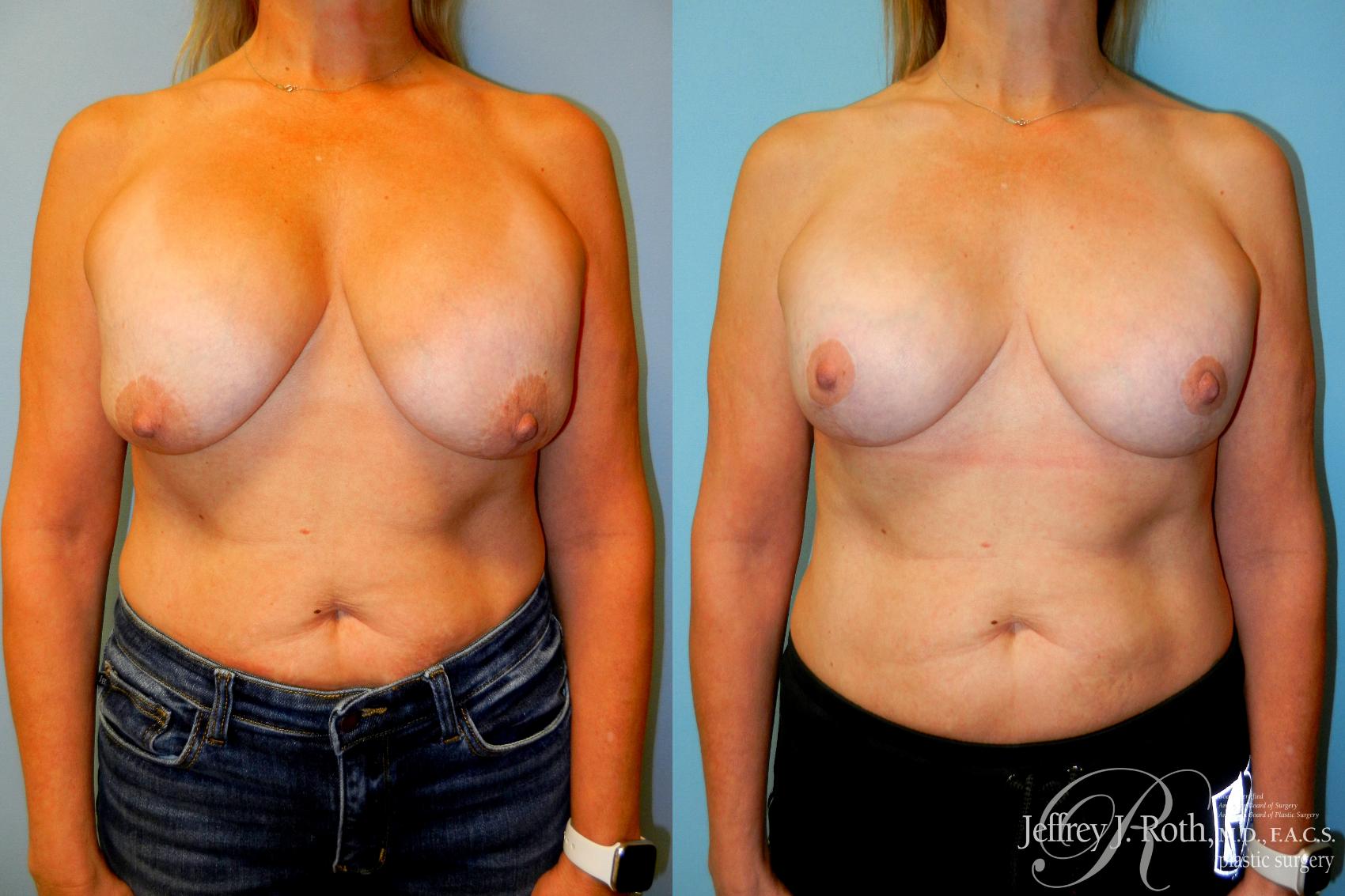 Before & After Breast Lift With Implants Case 257 Front View in Las Vegas and Henderson, NV