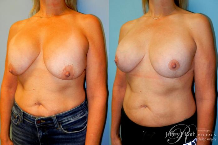 Before & After Breast Lift With Implants Case 257 Left Oblique View in Las Vegas and Henderson, NV