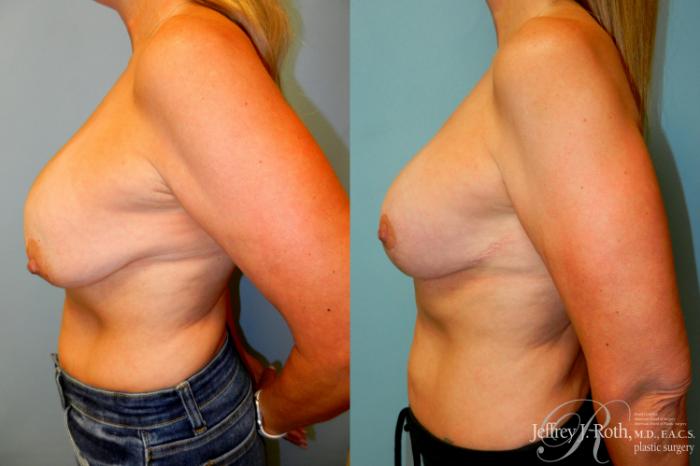 Before & After Breast Lift With Implants Case 257 Left Side View in Las Vegas and Henderson, NV