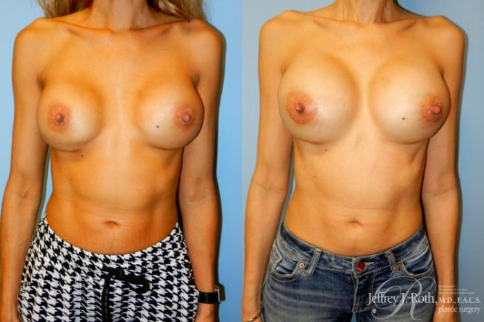 Before & After Breast Augmentation Revision Case 261 Front View in Las Vegas, NV