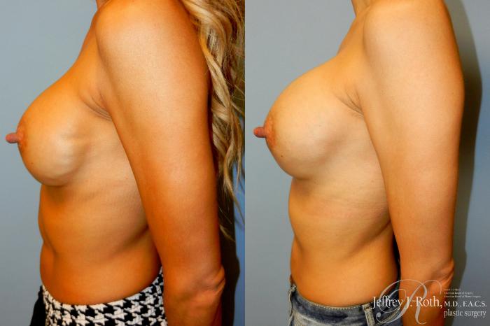 Before & After Breast Augmentation Revision Case 261 Left Side View in Las Vegas and Henderson, NV