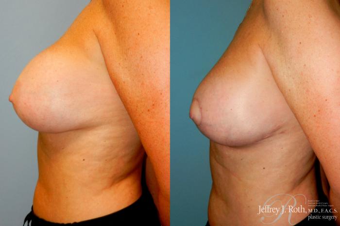 Before & After Breast Augmentation Revision Case 266 Left Side View in Las Vegas and Henderson, NV