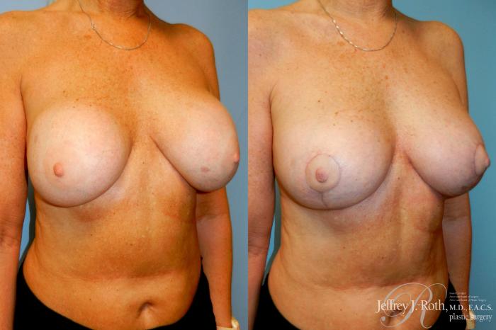 Before & After Breast Augmentation Revision Case 266 Right Oblique View in Las Vegas and Henderson, NV