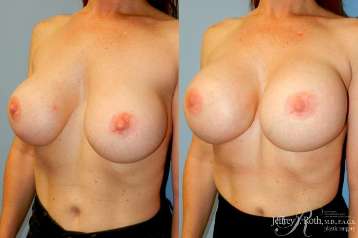 Before & After Breast Augmentation Revision Case 267 Left Oblique View in Las Vegas and Henderson, NV