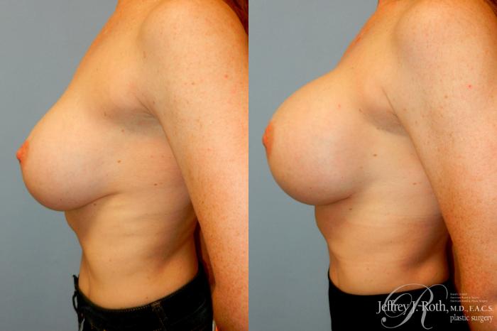 Before & After Breast Augmentation Revision Case 267 Left Side View in Las Vegas and Henderson, NV