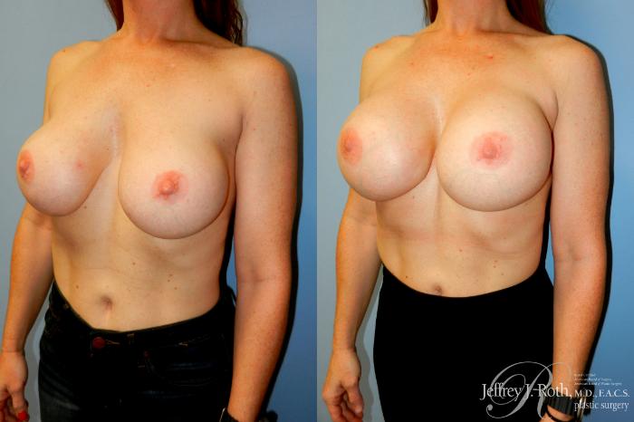 Before & After Breast Augmentation Revision Case 272 Left Oblique View in Las Vegas and Henderson, NV