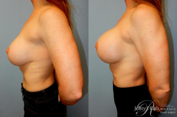 Before & After Breast Augmentation Revision Case 272 Left Side View in Las Vegas and Henderson, NV