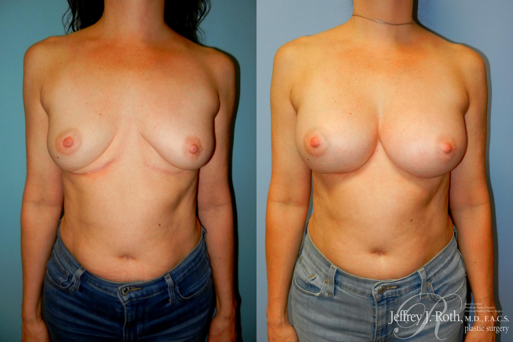 Before & After Breast Augmentation Revision Case 273 Front View in Las Vegas and Henderson, NV