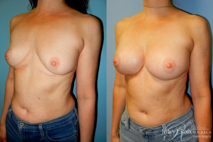 Before & After Breast Augmentation Revision Case 273 Left Oblique View in Las Vegas and Henderson, NV