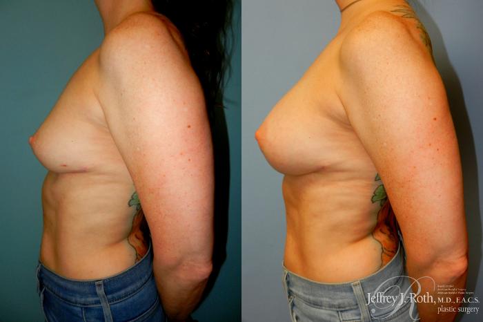 Before & After Breast Augmentation Revision Case 273 Left Side View in Las Vegas and Henderson, NV
