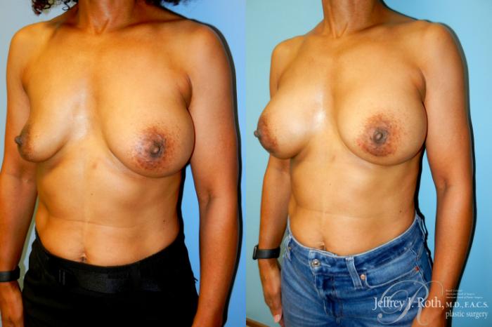 Before & After Breast Augmentation Revision Case 300 Left Oblique View in Las Vegas and Henderson, NV