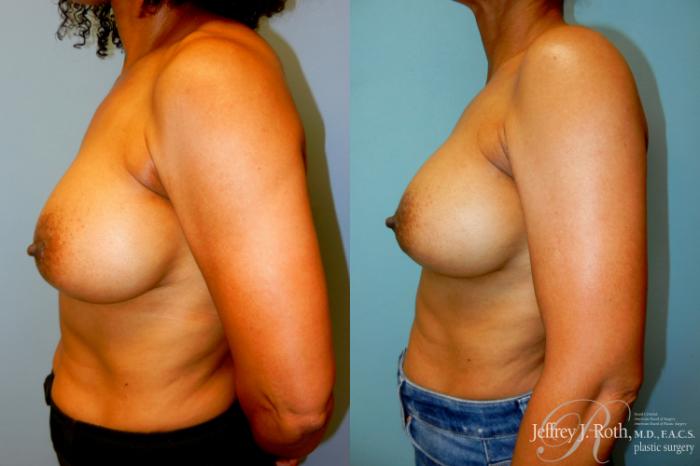 Before & After Breast Augmentation Revision Case 300 Left Side View in Las Vegas and Henderson, NV