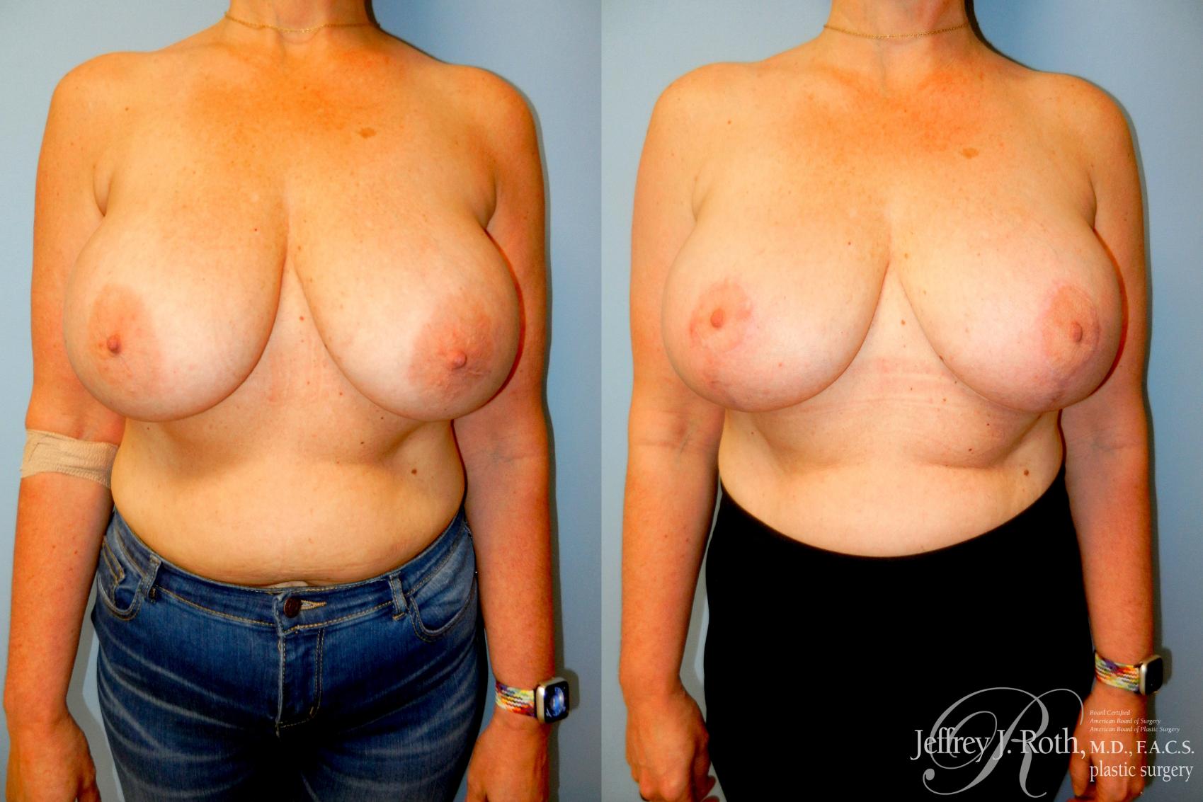 Before & After Breast Augmentation Revision Case 301 Front View in Las Vegas and Henderson, NV