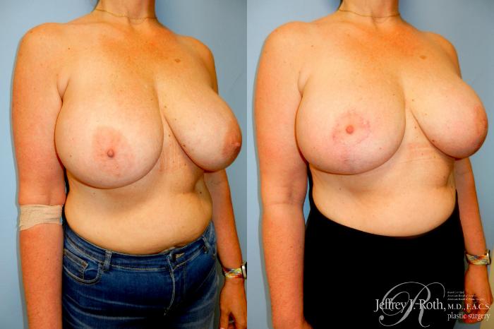 Before & After Breast Augmentation Revision Case 301 Right Oblique View in Las Vegas and Henderson, NV