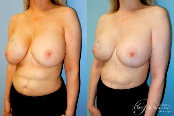 Before & After Breast Augmentation Revision Case 308 Left Oblique View in Las Vegas and Henderson, NV