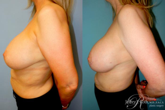 Before & After Breast Augmentation Revision Case 308 Left Side View in Las Vegas and Henderson, NV