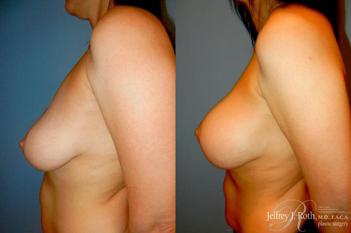Before & After Breast Augmentation Revision Case 317 Left Side View in Las Vegas and Henderson, NV