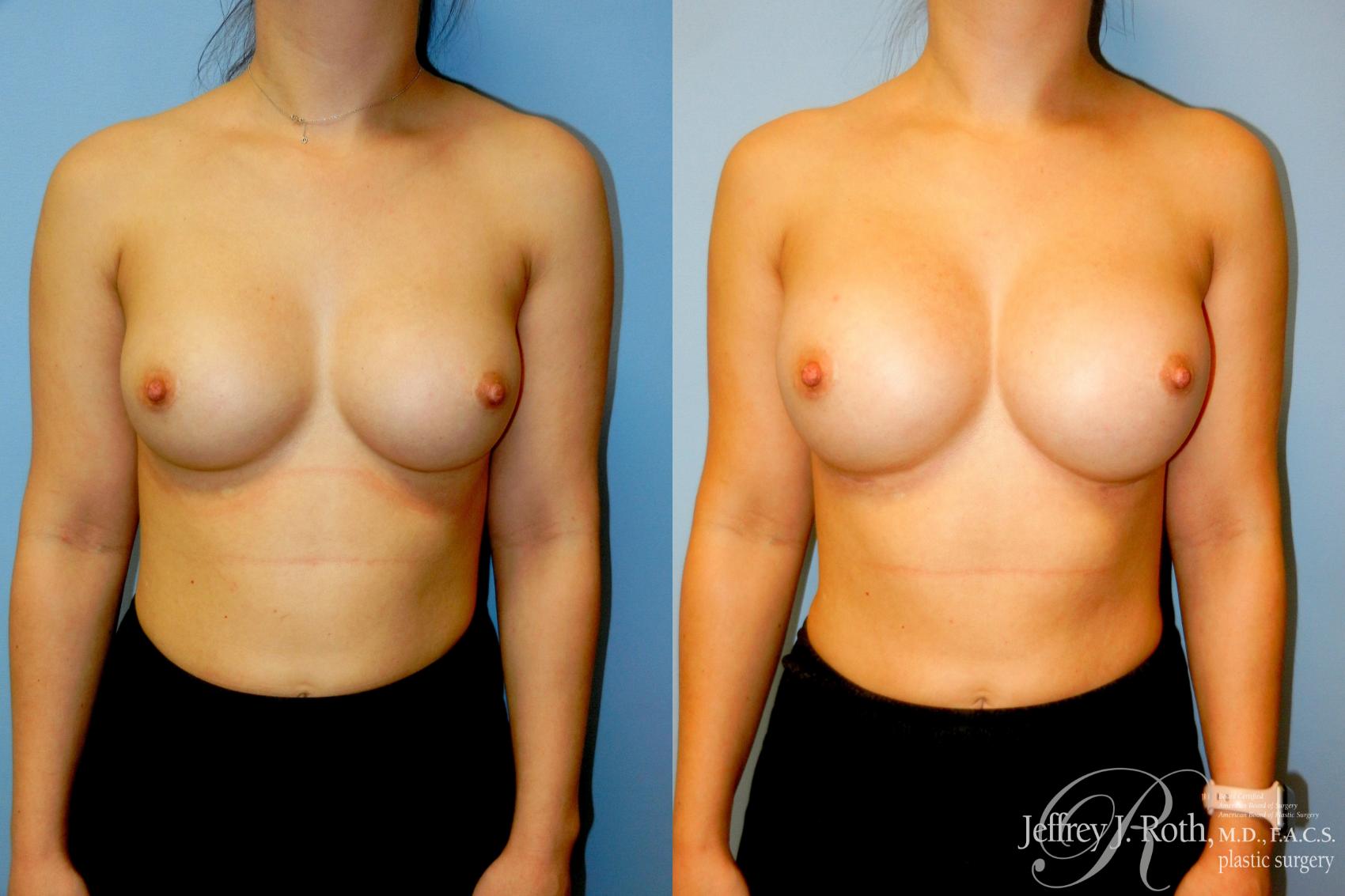 Before & After Breast Augmentation Revision Case 318 Front View in Las Vegas and Henderson, NV