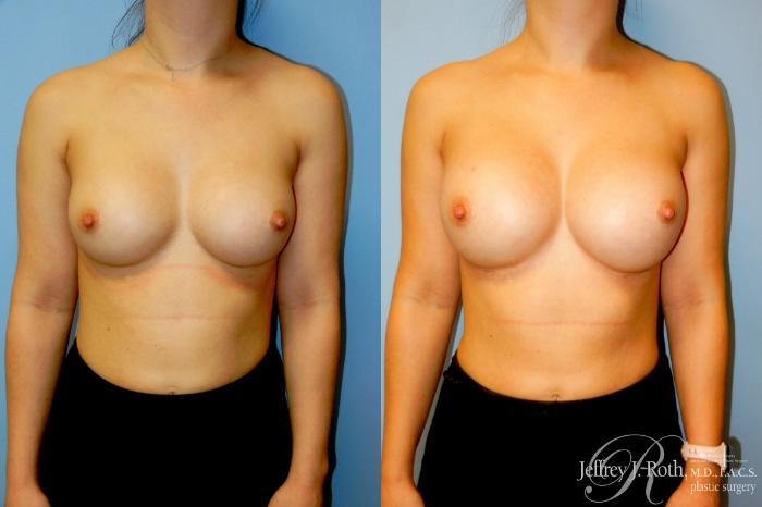 Before & After Breast Augmentation Revision Case 318 Front View in Las Vegas and Henderson, NV