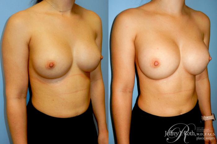 Before & After Breast Augmentation Revision Case 318 Right Oblique View in Las Vegas and Henderson, NV