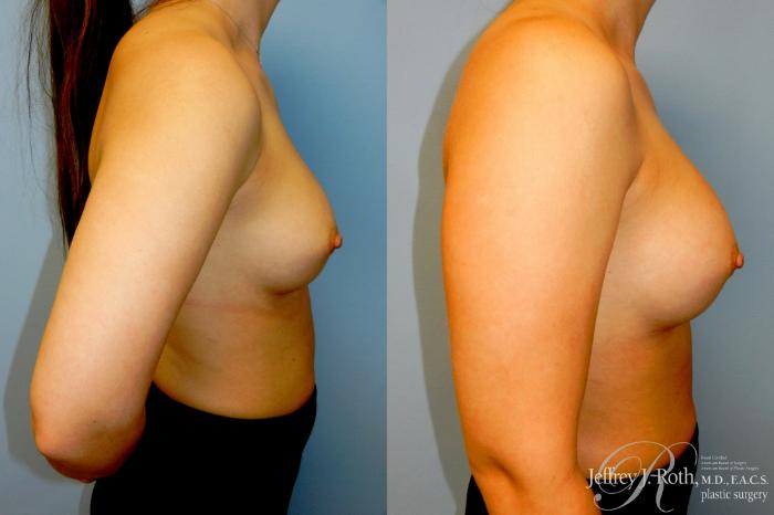 Before & After Breast Augmentation Revision Case 318 Right Side View in Las Vegas and Henderson, NV