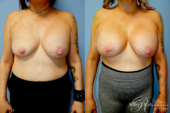 Before & After Breast Augmentation Revision Case 321 Front View in Las Vegas and Henderson, NV