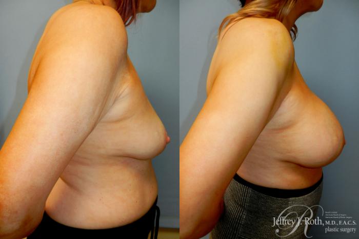 Before & After Breast Augmentation Revision Case 321 Right Side View in Las Vegas and Henderson, NV